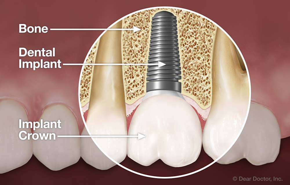 Dental Implants Columbia Mo Drs Davis Miller And Lyle 